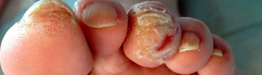 Imagem do acervo de tratamentos sobre cuidados com pés diabéticos